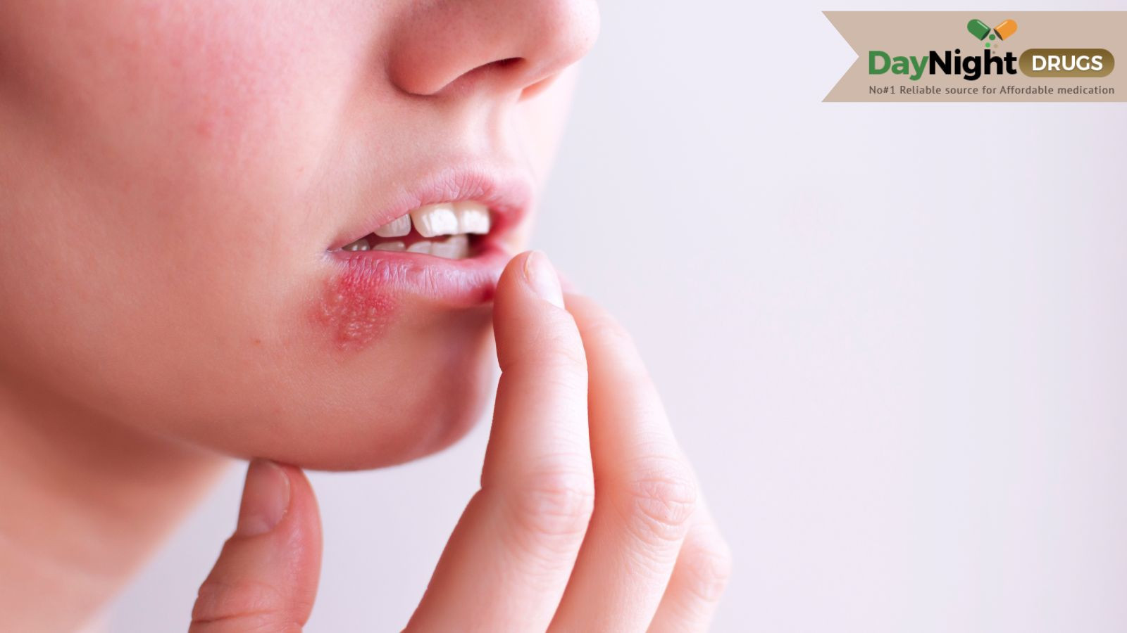 A girl suffering from the outbreak of Cold Sores 