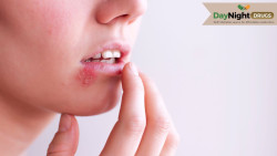 Valtrex for Cold Sores: How Long Does It Take to Work?