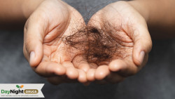 Does stress cause hair loss?