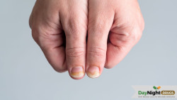 How to Get Rid of Fingernail Fungus Fast?